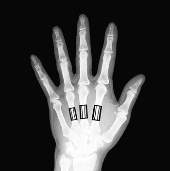 Image: With a single, standard X-ray image of the hand, acquired on a mammography modality, it is possible to measure women’s bone health (Photo courtesy of Sectra).